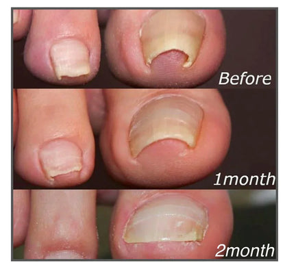 Quick Nail Repair Patches For Strong Nails
