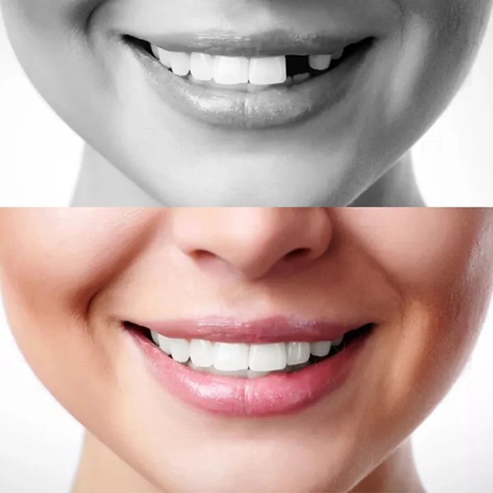 Custom Fit Dental False Teeth - Hehif