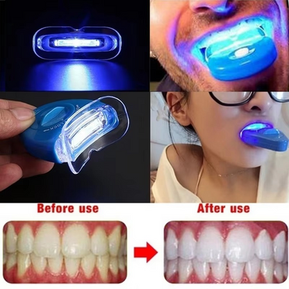 Professional At Home Teeth Whitening Kit